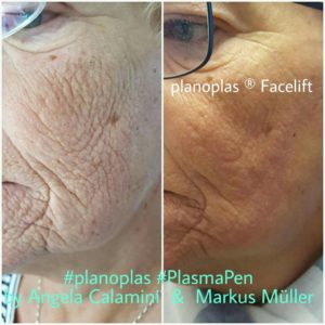 Cheek-Planoplas® Plasma Pen before and after