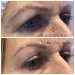 Eye Treatment -Planoplas® Plasma Pen before and after