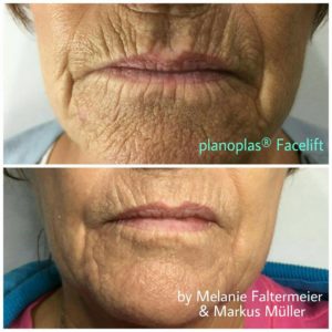 Oral area -Planoplas® Plasma Pen before and after