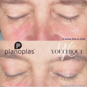Upper eye - Planoplas® Plasma Pen before and after