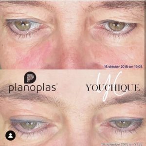 Upper eye -Planoplas® Plasma Pen before and after