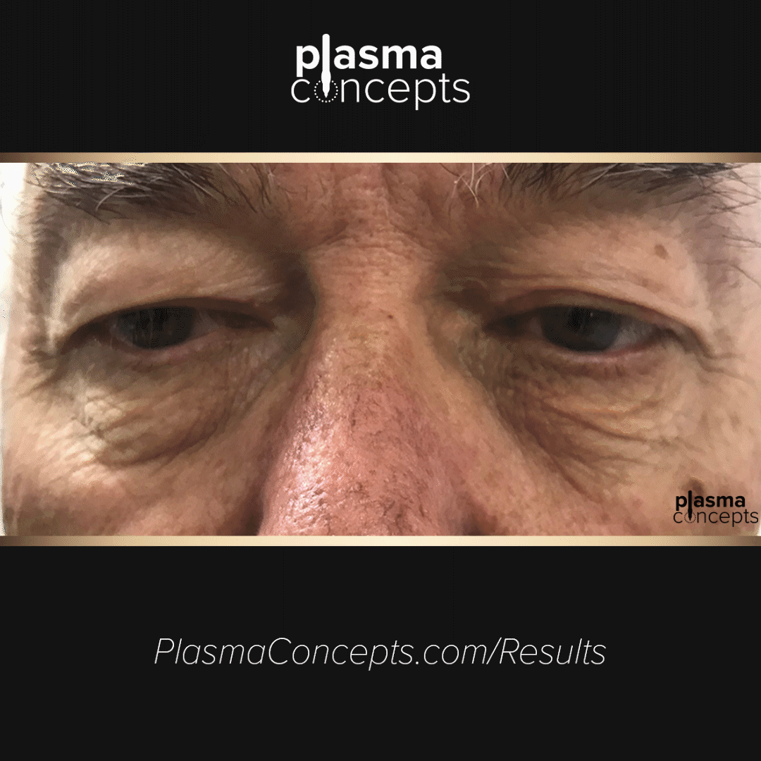 Plasma-Pen-Treatment-Before-and-After-by-Plasma-Concept