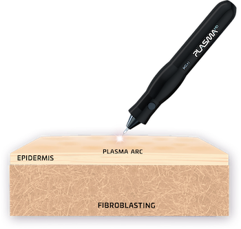 Plasma-Pen-Fibroblasting